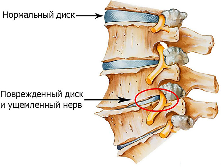 Как долго болит спина после защемления