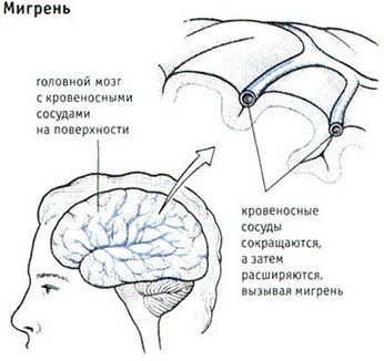 мигрень сколько может болеть голова