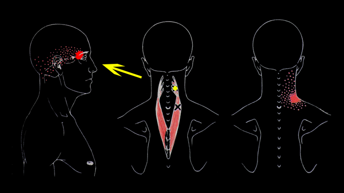 ÁÎËÈÒ ÃÎËÎÂÀ È ØÅß: ðåìåííàÿ ìûøöà ãîëîâû è øåè Çäîðîâüå, Ìåäèöèíà, Ìàññàæ, Àíàòîìèÿ, Âèäåî, Ãèôêà, Äëèííîïîñò