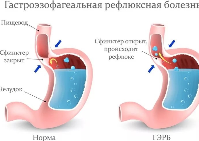 Причины желудочно – пищеводного рефлюкса