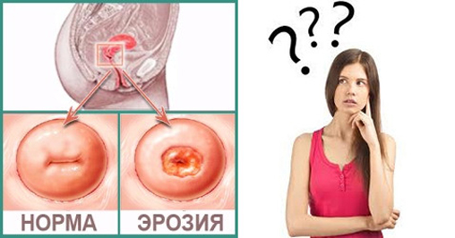 При эрозии может болеть спина