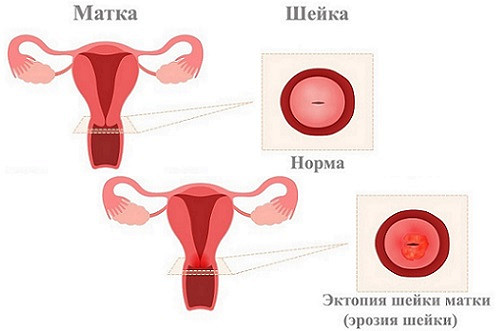 При эрозии может болеть спина