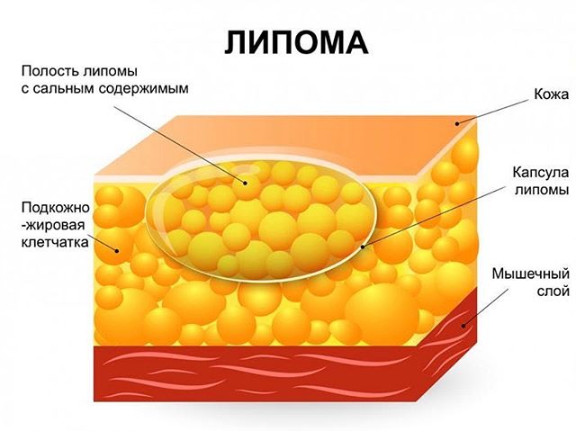 На спине шишка которая болит что это