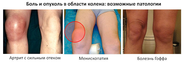 возможные патологии, при которых опухает колено