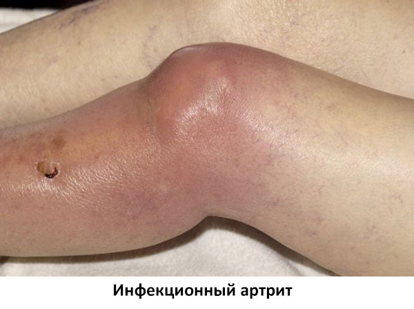 инфекционный артрит