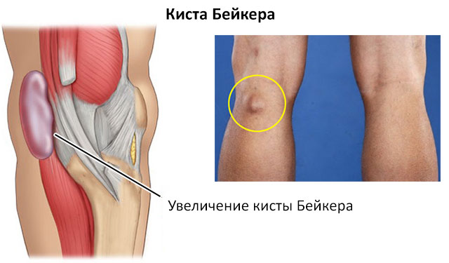 киста Бейкера
