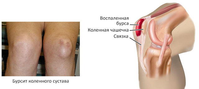 бурсит коленного сустава