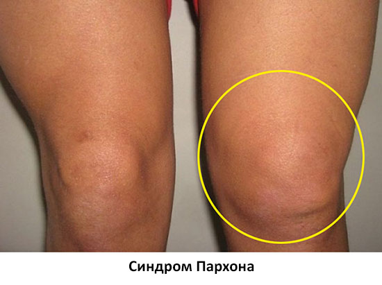 синдром пархона