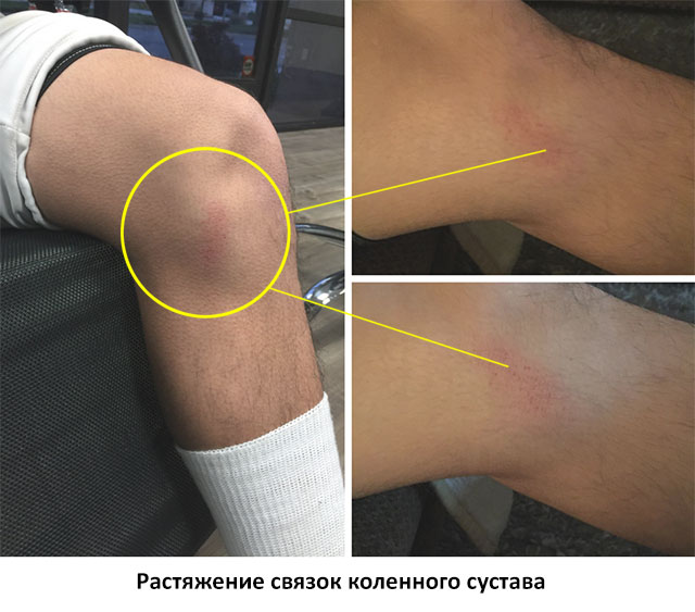 растяжение связок