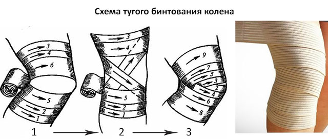 тугое бинтование колена