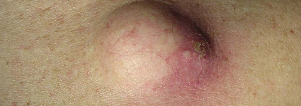 На спине шишка которая болит что это