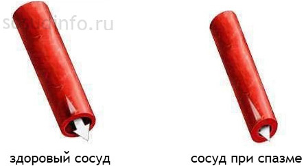 Болит сосуд в голове слева