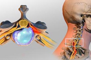 может ли болеть голова от шейной грыжи