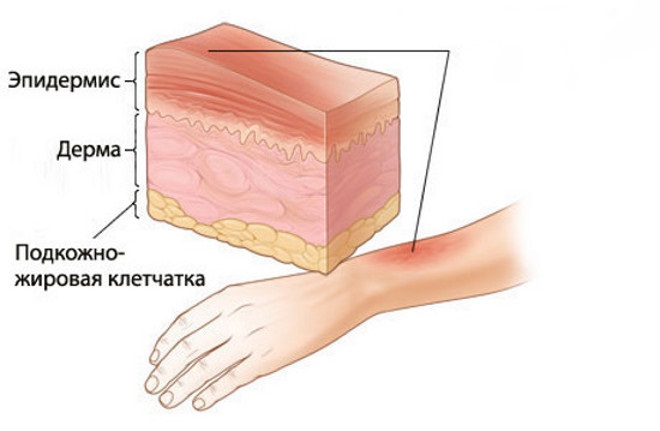 ссадина на спине красная и болит