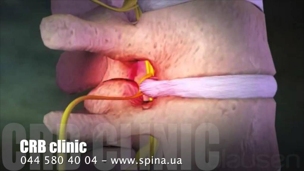 Что делать если болит спина внизу позвоночника