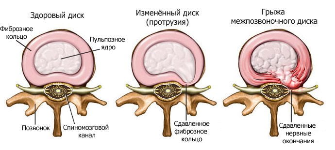Сравнение здорового диска и пораженного межпозвоночной грыжей Межпозвоночная грыжа