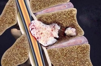 Болит спина может быть рак