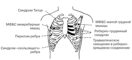 Синдром скользящего ребра Синдром скользящего ребра