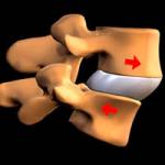 Смещение позвонков