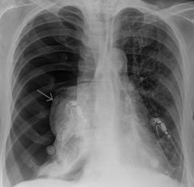Часто болит правый бок и отдает в спину