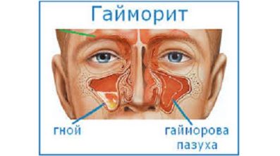 Температура и болит правая сторона спины