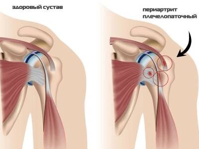 болит голова и отдает в шею с левой стороны болит плечо и рука