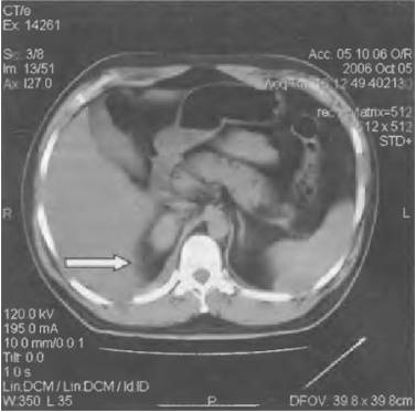 Часто болит правый бок и отдает в спину