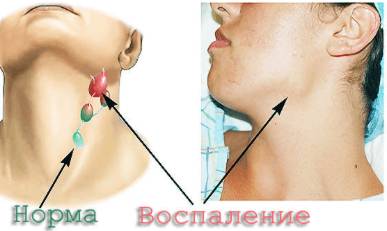 Температура и болит правая сторона спины