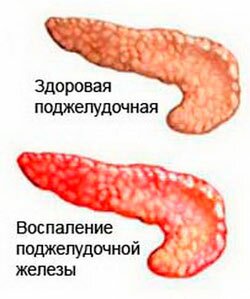 Заболеваание панкреатит