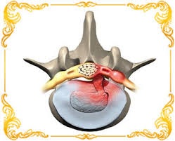 Боли после удаления грыжи диска Боли после удаления грыжи диска