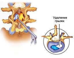 Боли после операции удаления грыжи диска Боли после операции удаления грыжи диска
