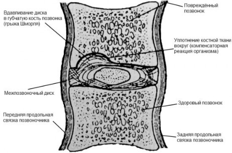 Боль после операции по удалению грыжи диска Боль после операции по удалению грыжи диска