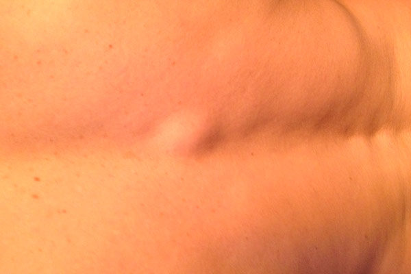 На спине шишка которая болит что это