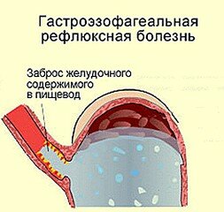 ГЭРБ гастроэзофагеальная рефлюксная болезнь