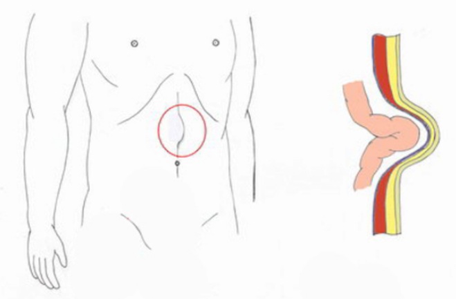 Грыжа мечевидного отростка Грыжа мечевидного отростка