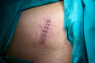 На спине шишка которая болит что это