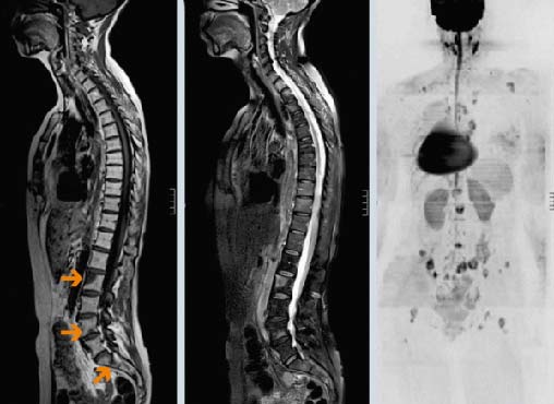 Болит спина при онкологии