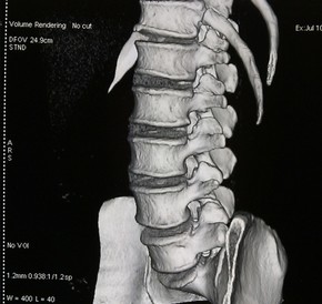 Клинический случай эффективного лечения сильной боли в спине после 5 безуспешных нейрохирургических операций Клинический случай эффективного лечения сильной боли в спине после 5 безуспешных нейрохирургических операций