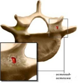 На спине шишка которая болит что это
