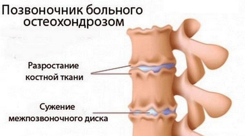 Болит спина в области лопаток врачи
