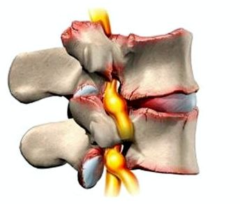 болит голова и отдает в шею с левой стороны болит плечо и рука