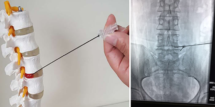 Болит спина при онкологии