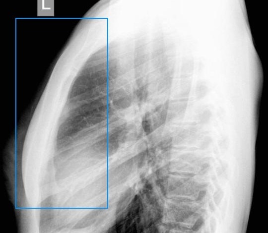 Рентген грудины и мечевидного отростка Рентген грудины и мечевидного отростка