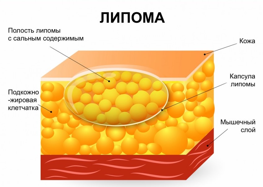 Шишка на голове. Что это может быть, если сзади, под кожей не болит, твердая на затылке. Причины, как избавиться, к какому врачу обращаться