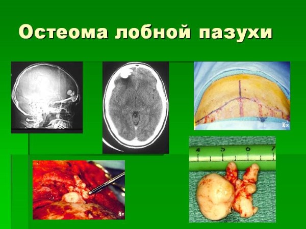 Шишка на голове. Что это может быть, если сзади, под кожей не болит, твердая на затылке. Причины, как избавиться, к какому врачу обращаться