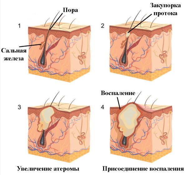 Шишка на голове. Что это может быть, если сзади, под кожей не болит, твердая на затылке. Причины, как избавиться, к какому врачу обращаться