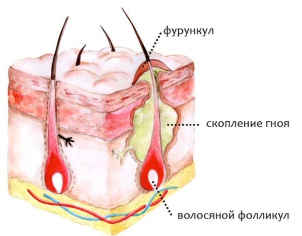 Шишка на голове. Что это может быть, если сзади, под кожей не болит, твердая на затылке. Причины, как избавиться, к какому врачу обращаться