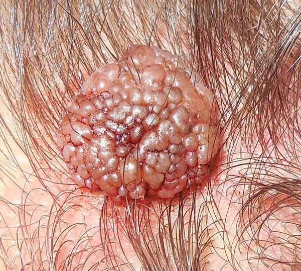 Шишка на голове. Что это может быть, если сзади, под кожей не болит, твердая на затылке. Причины, как избавиться, к какому врачу обращаться