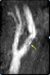 стеноз ВСА при МРА