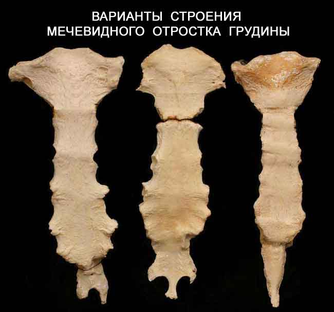 Варианты мечевидных отростков